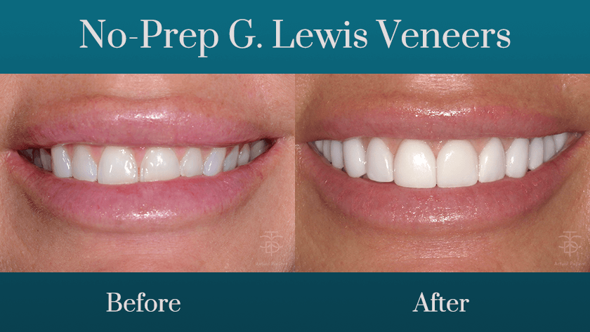 no-prep g. lewis veneer